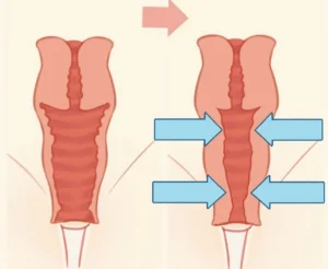 Vaginoplastie