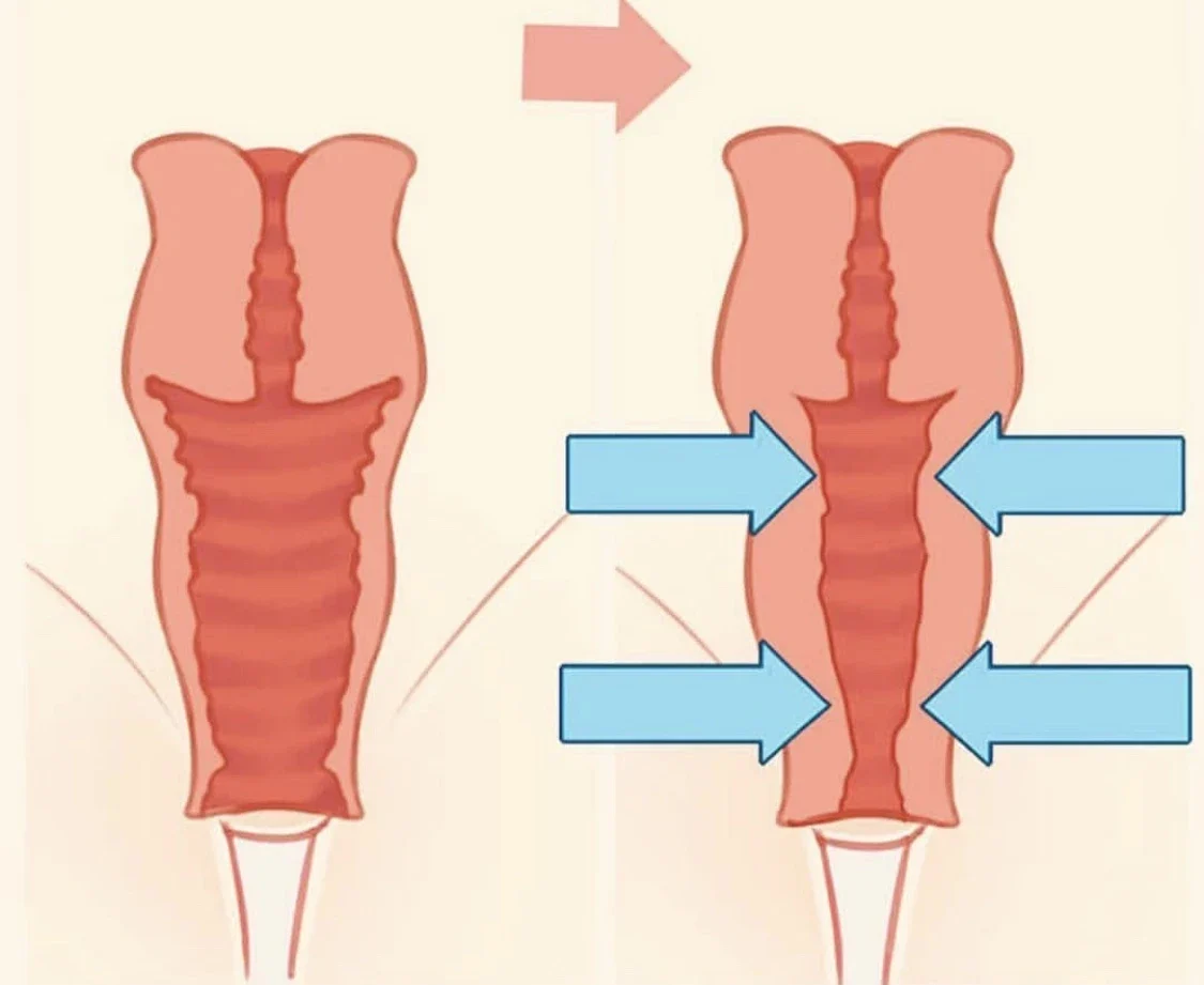 Vaginoplastie