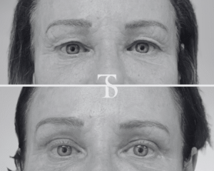 Blépharoplastie avant après