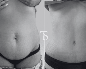 Abdominoplastie avant après