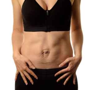 Diastasis