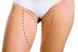 Lifting cuisses