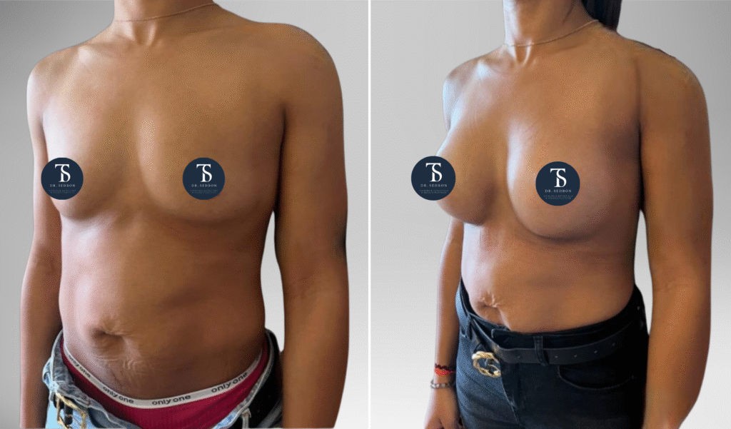 Augmentation mammaire Theo Sedbon