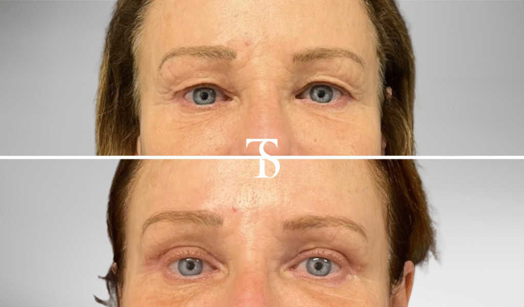 avant après theo sedbon