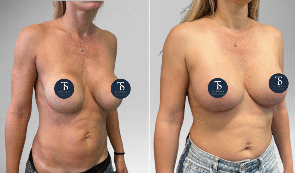 avant après theo sedbon