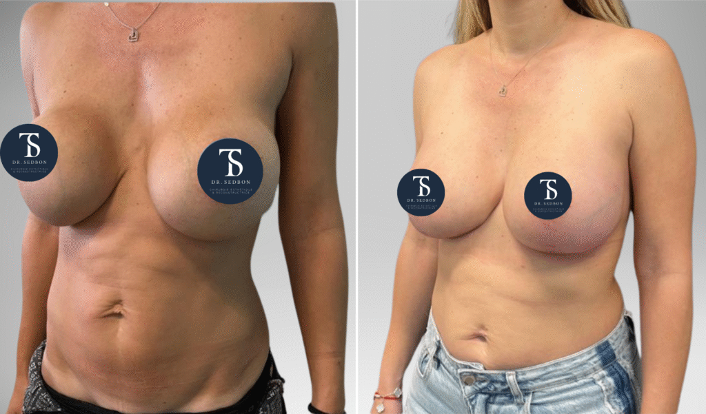 avant après theo sedbon