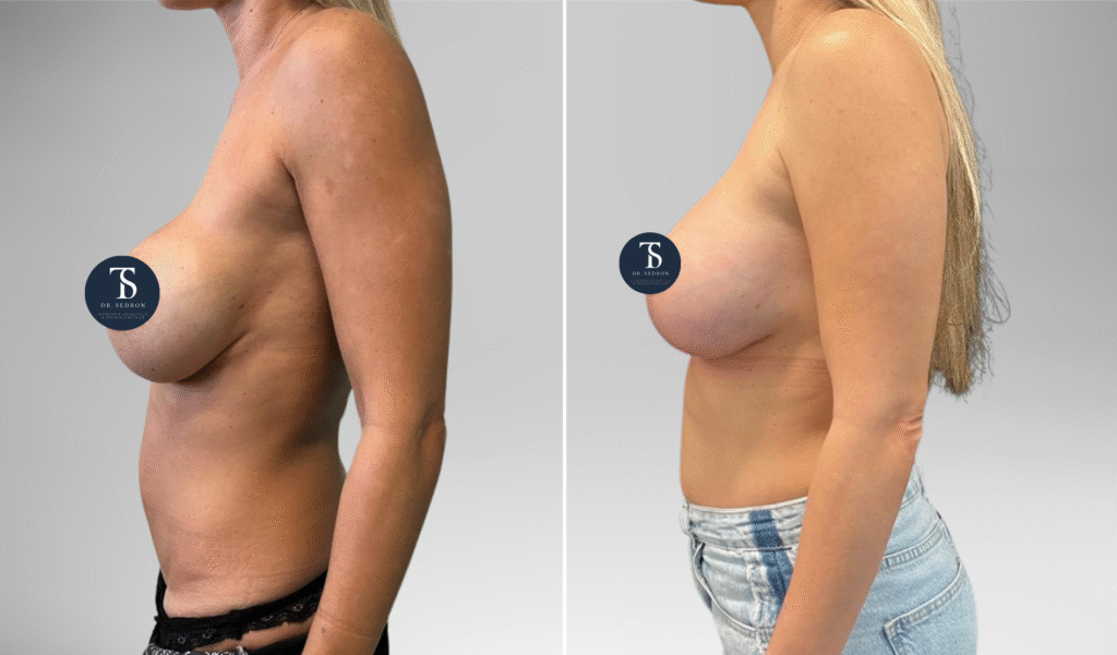 avant après theo sedbon