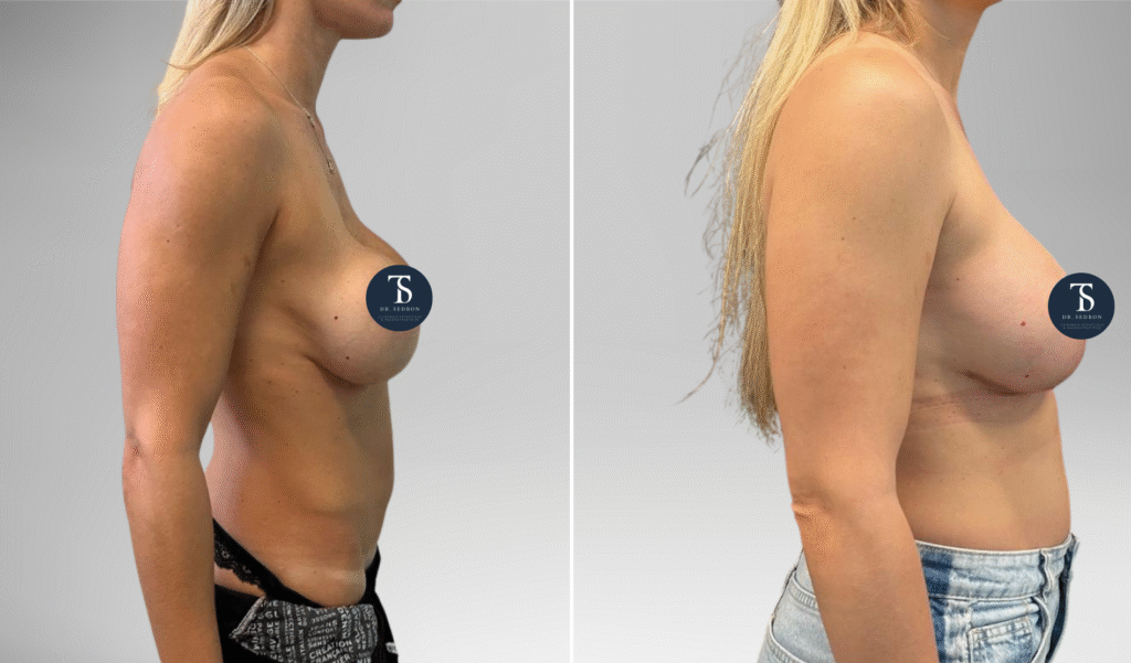 avant après theo sedbon