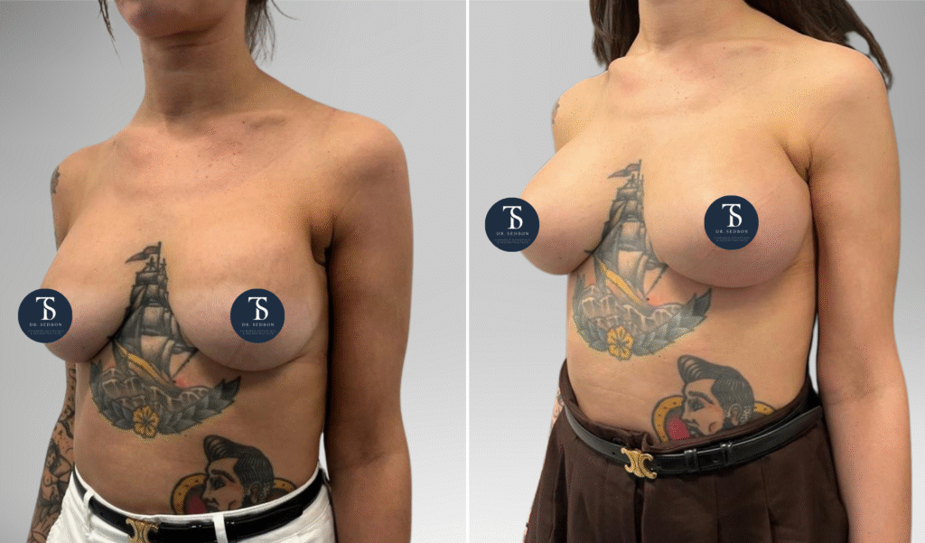 avant après theo sedbon