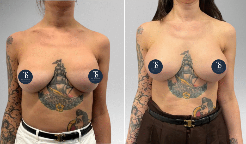 avant après theo sedbon