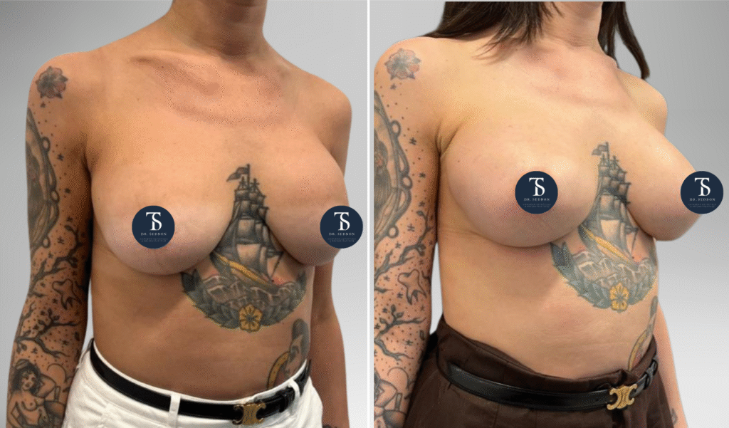 avant après theo sedbon