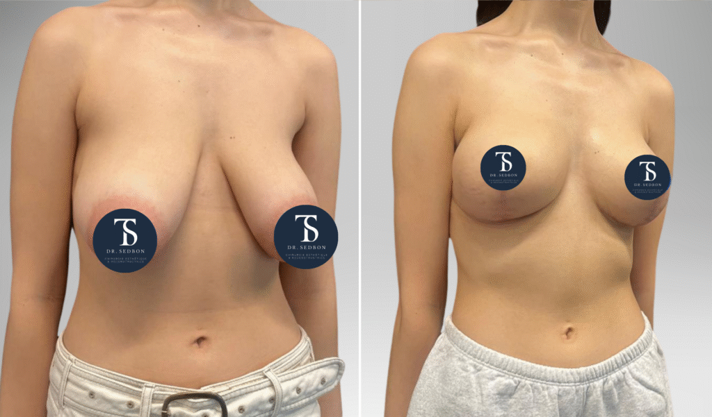 avant après theo sedbon