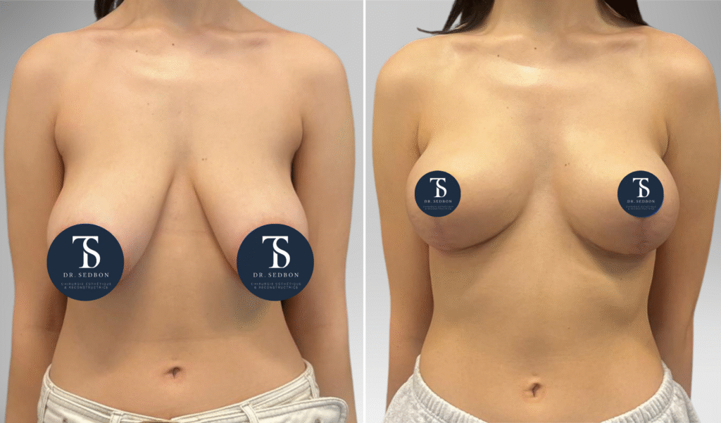 avant après theo sedbon