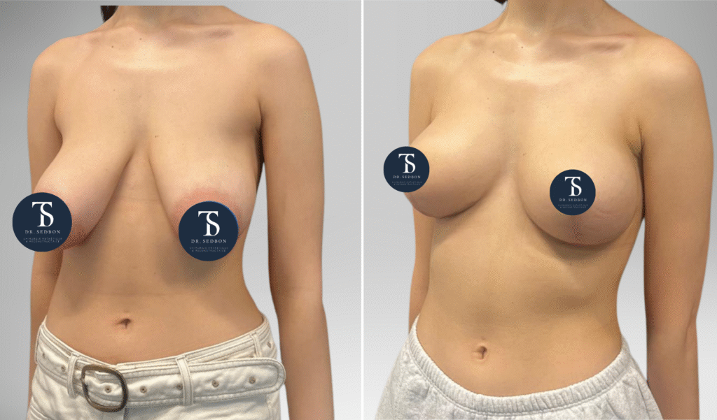 avant après theo sedbon