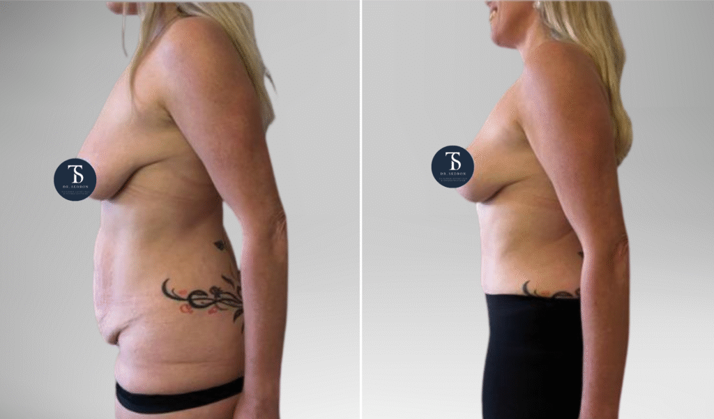 avant après theo sedbon