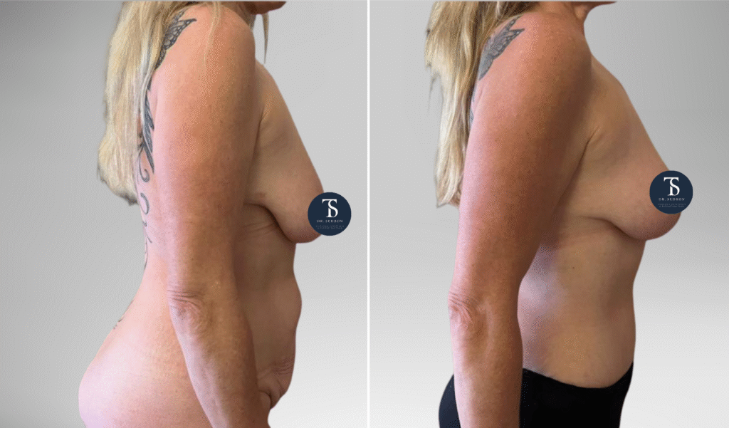 avant après theo sedbon