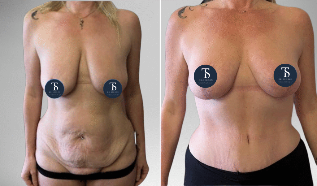 avant après theo sedbon