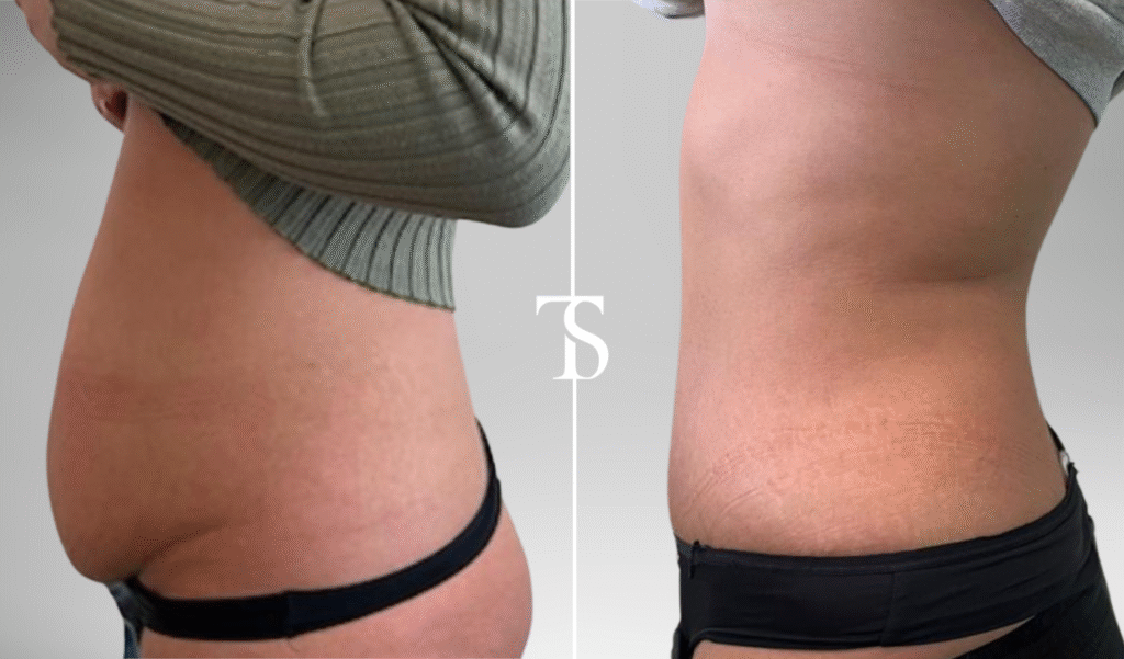 avant après theo sedbon