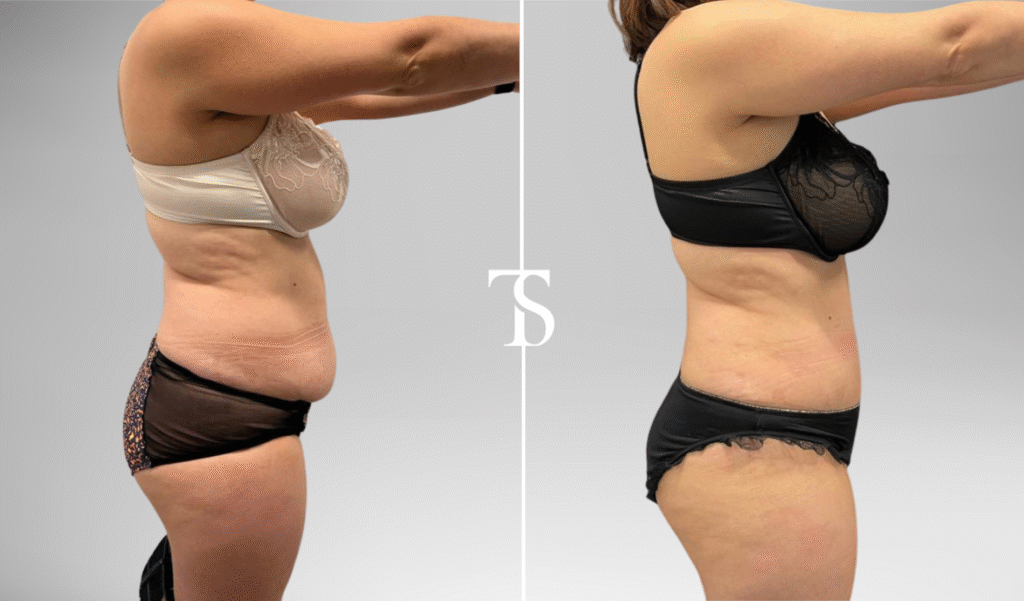 avant après theo sedbon