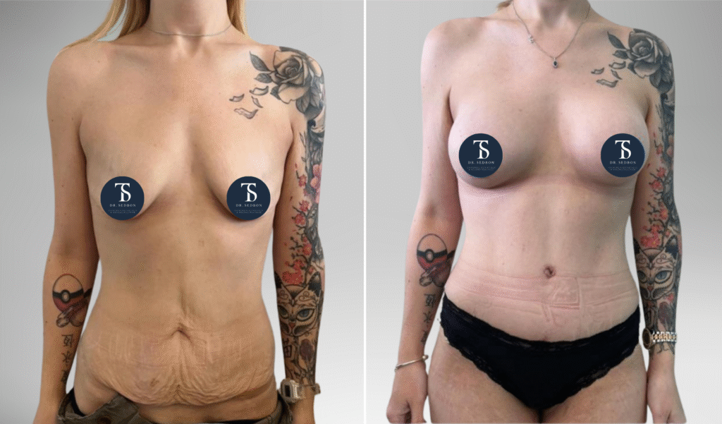 abdominoplastie