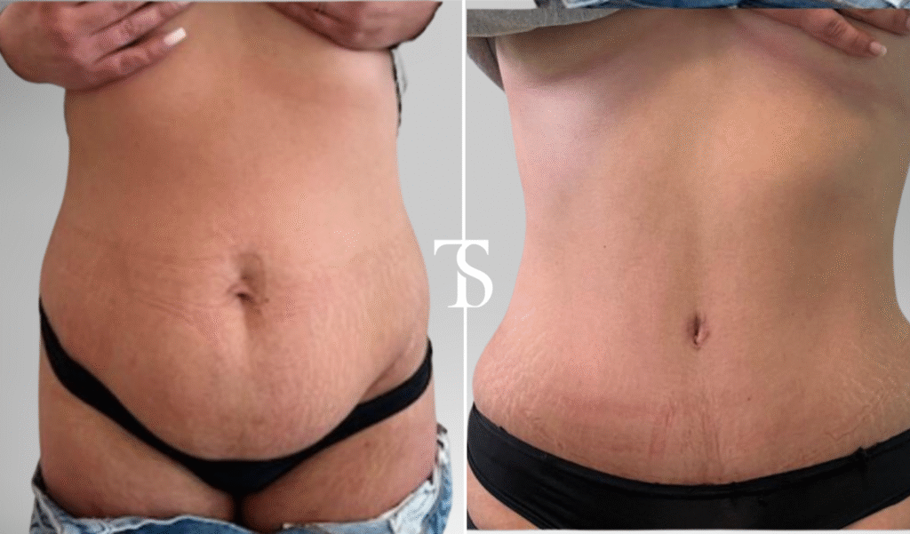 avant après theo sedbon