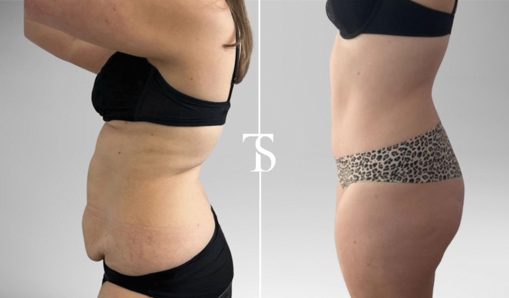 avant après theo sedbon