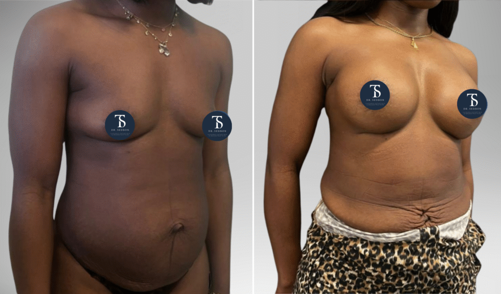 avant après theo sedbon