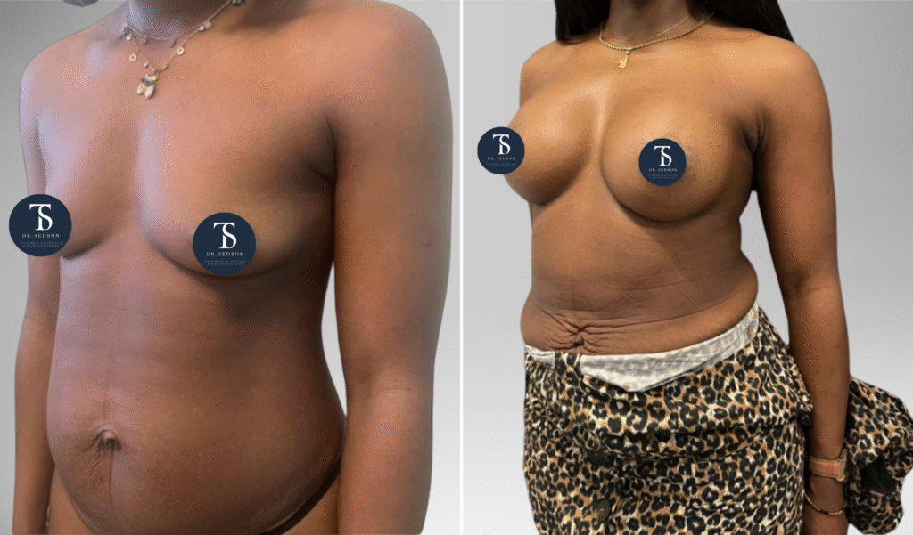 avant après theo sedbon