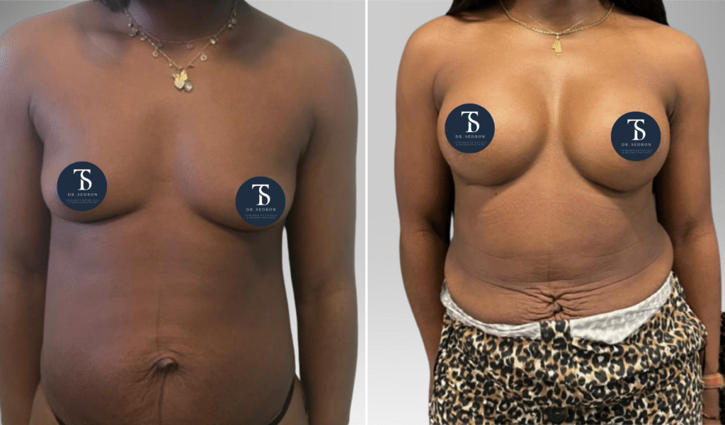 avant après theo sedbon