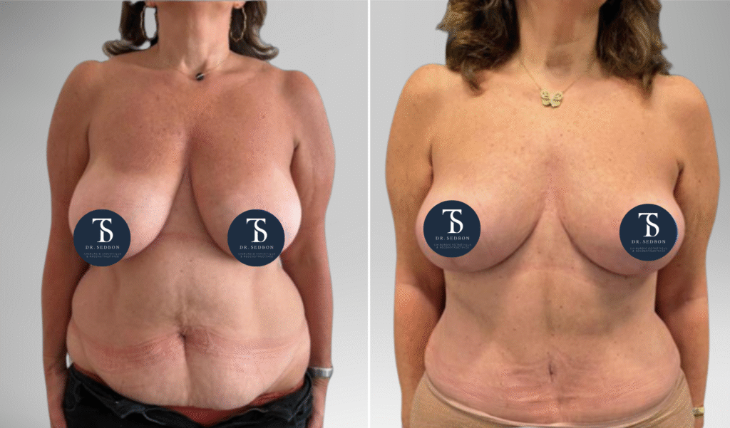 avant après theo sedbon