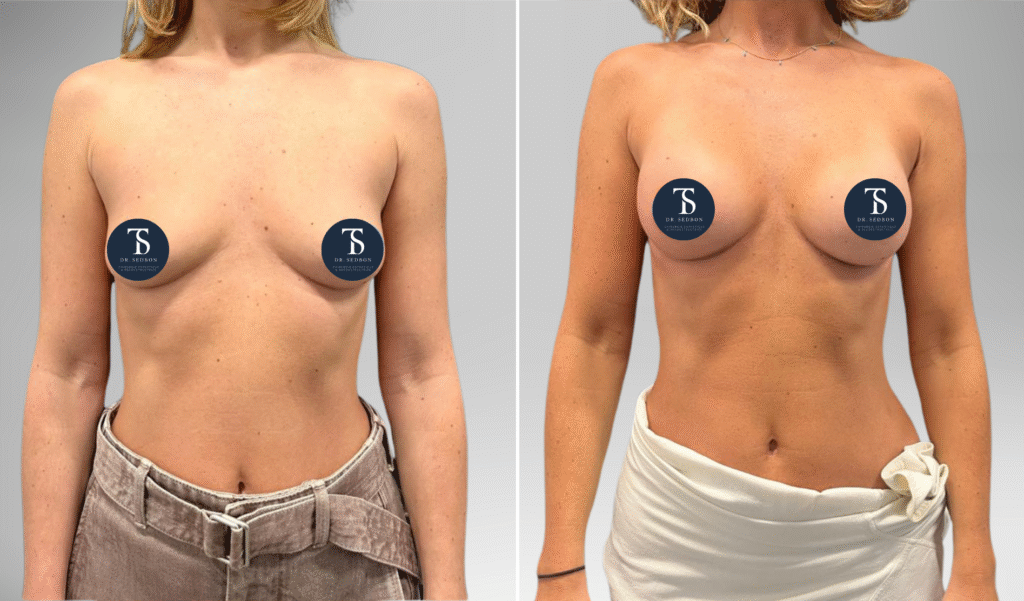 avant après theo sedbon