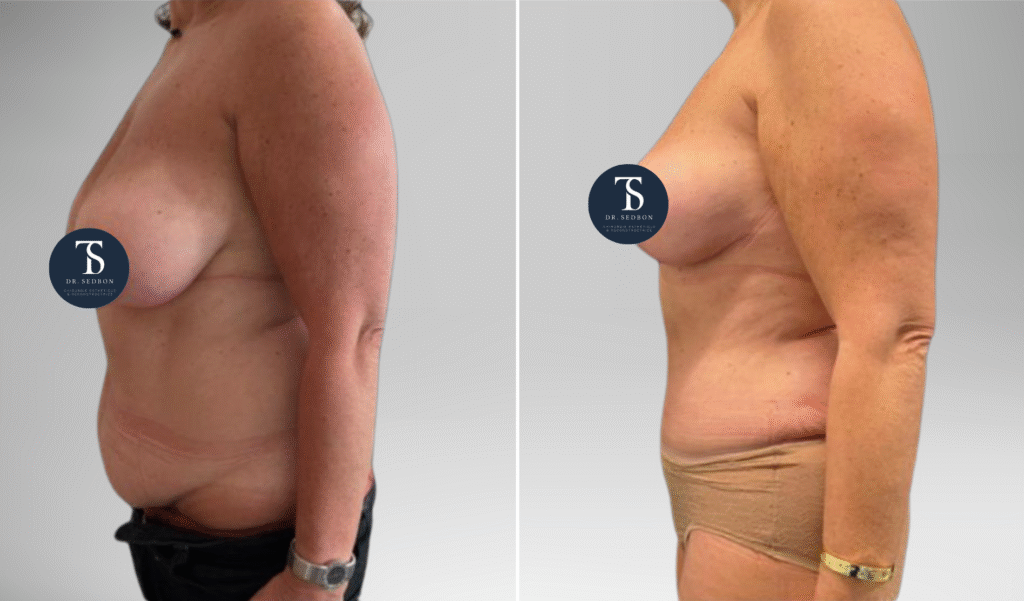 avant après theo sedbon