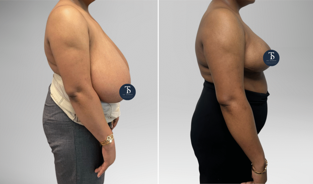 avant après theo sedbon