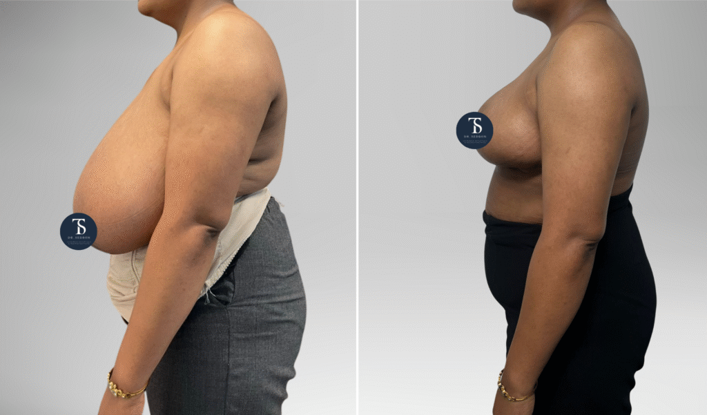 avant après theo sedbon