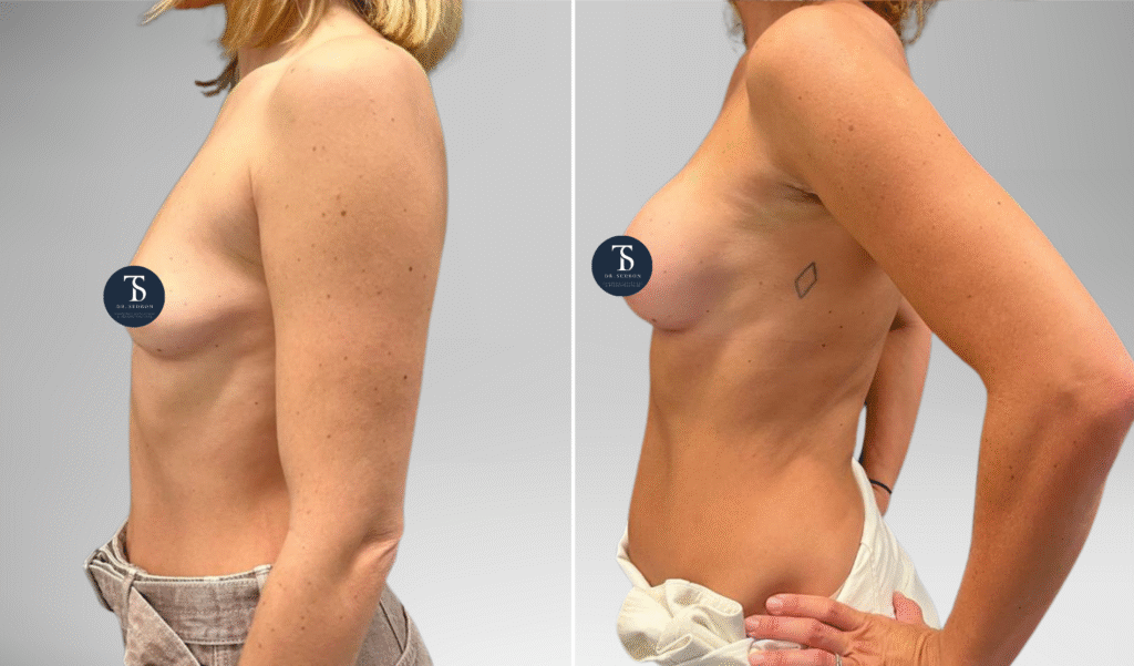 avant après theo sedbon