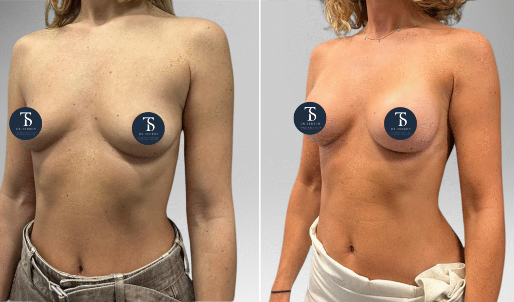 avant après theo sedbon