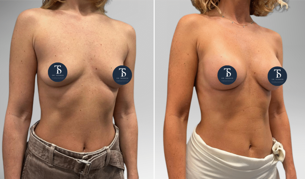 avant après theo sedbon