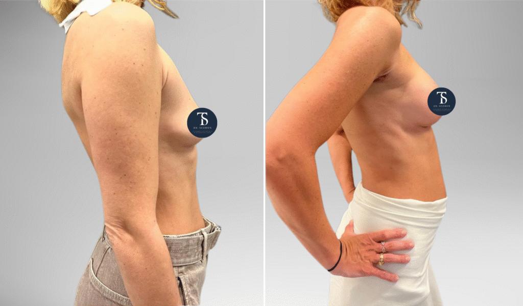 avant après theo sedbon