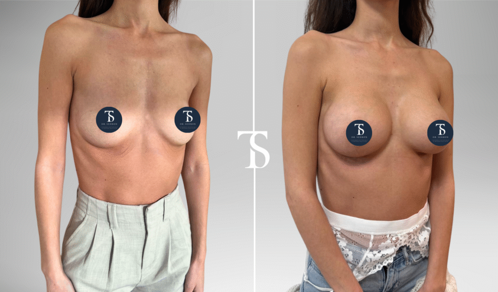 avant après theo sedbon