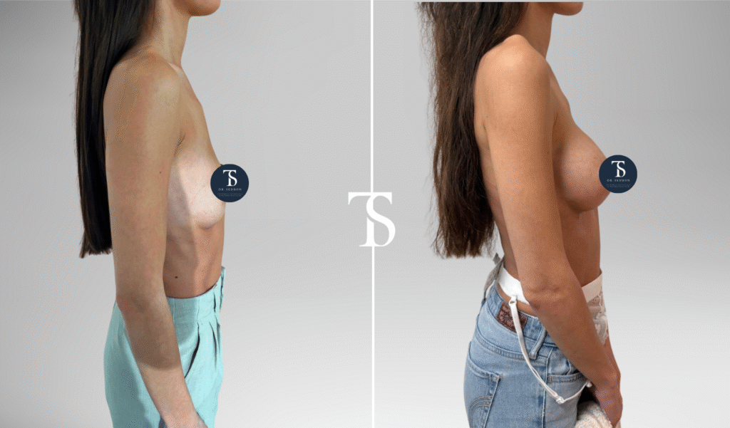 avant après theo sedbon