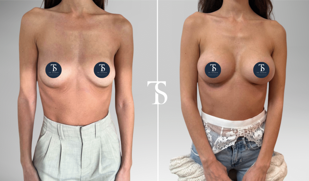 Augmentation mammaire avant après