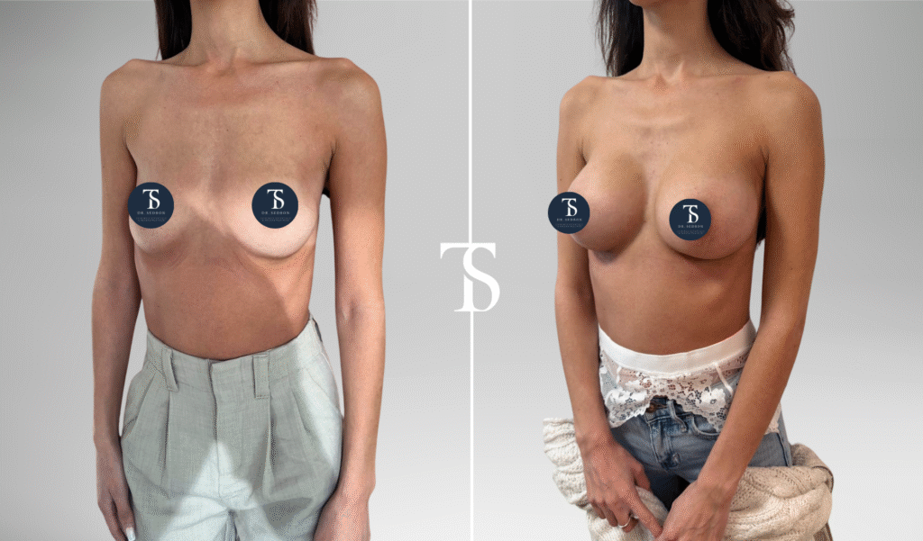 Augmentation mammaire avant après