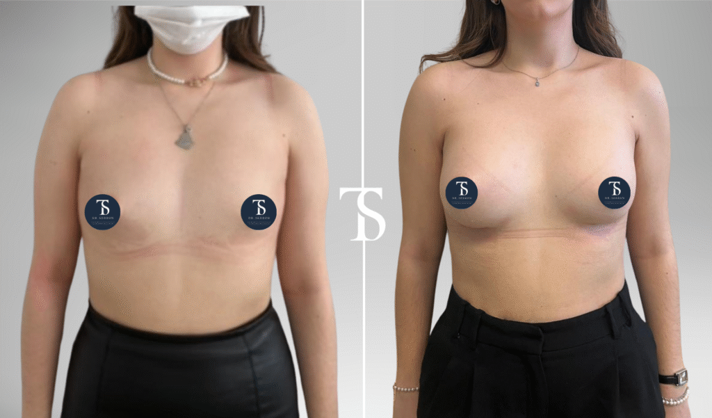 Augmentation mammaire avant après