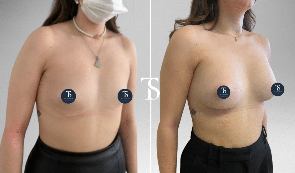 Augmentation mammaire avant après