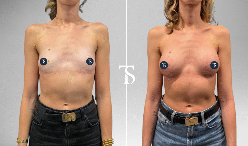 Augmentation mammaire avant après