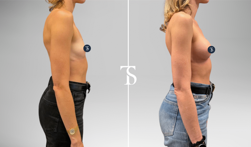 Augmentation mammaire avant après