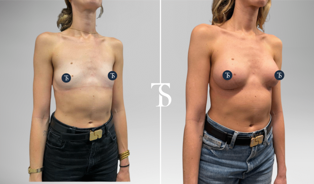 Augmentation mammaire avant après
