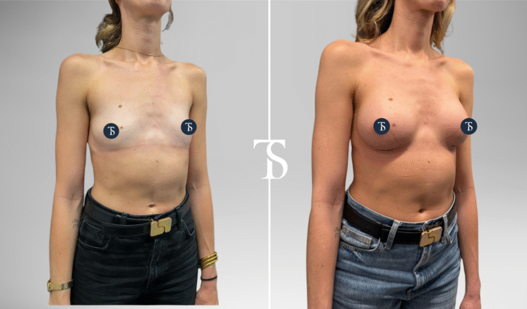 Augmentation mammaire avant après
