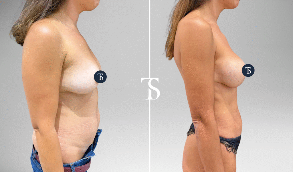 avant après theo sedbon