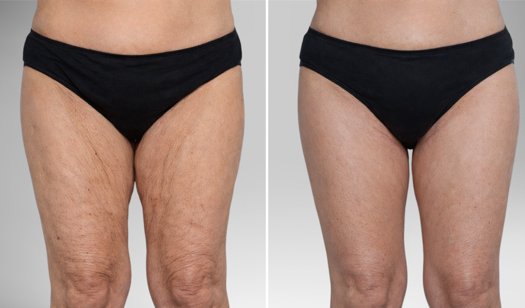 lifting cuisse avant après​